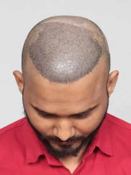 A remarkable 9-month transformation. We used 5000 grafts for hairline restoration and mid-scalp coverage, resulting in visible volume and confidence.