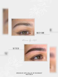 Brow Enhancement