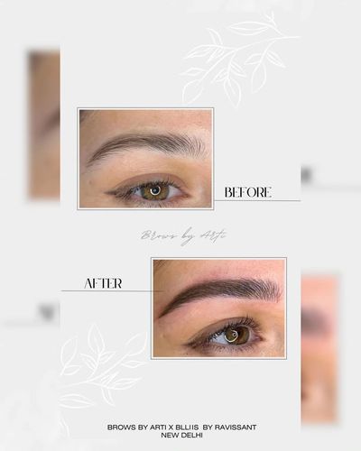 Brow Enhancement
