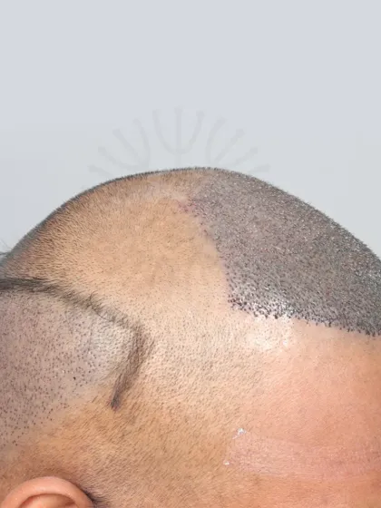 A Grade 4A hair loss case restored with 3500 grafts. These images show the precision of our graft placement.