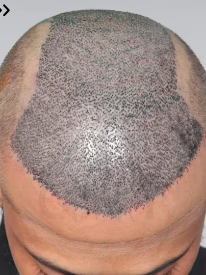 A look at the graft placement for a Norwood Grade 6 case. 5400 grafts were used to recreate the hairline, frontal part, mid-scalp, and crown.