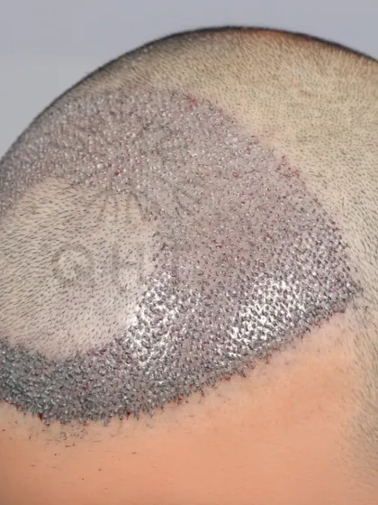 A high-density hair transplant where we preserved the patient's natural frontal tuft while restoring the surrounding areas with 3500 grafts.