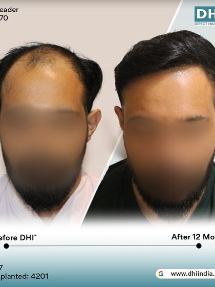 A before and after of a 37-year-old client 12 months post-procedure. With 4,201 hairs implanted, his hair is now dense, stylish, and completely natural-looking.
