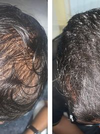 Hair Loss Treatment