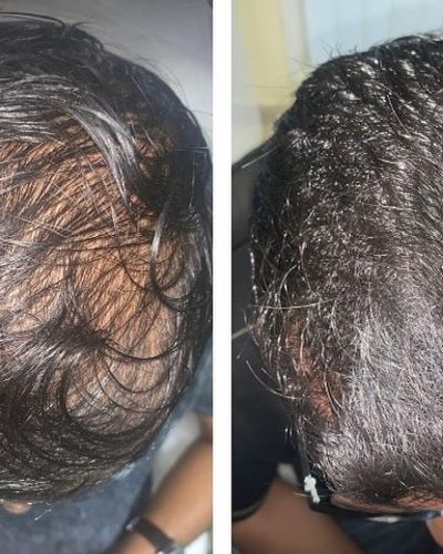 Hair Loss Treatment