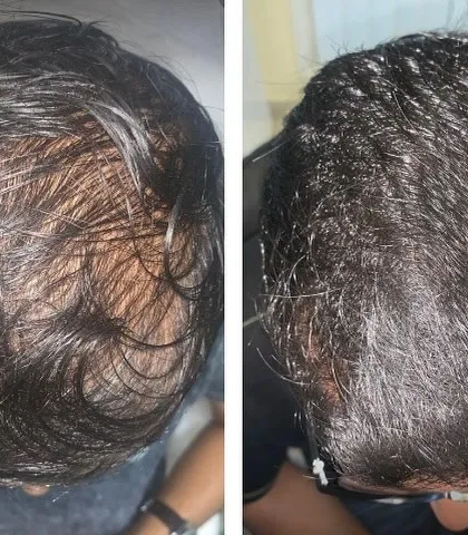 This image shows the significant improvement in hair density and scalp coverage for a patient after completing a customized hair regrowth plan. The goal of my treatment is not just to stop hair fall but to achieve tangible new growth, resulting in fuller and healthier hair.