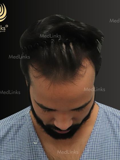 A top-down view of the patient's hair loss before the transplant.