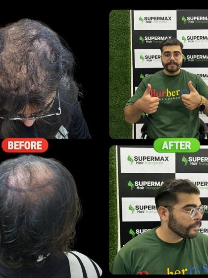 A powerful before and after. This client went from significant hair loss to a full, stylish haircut. This is the confidence I restore.