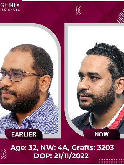 The top choice for natural restoration, this 32-year-old's Grade 4A hair loss was treated with 3203 grafts.