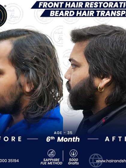 Another angle of this incredible 6-month transformation, showing how a well-crafted beard and hairline can work together.
