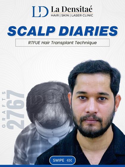 This "Scalp Diaries" post for Mr. Chiranjibi highlights the 2,767 grafts that made his transformation possible. It’s a story of how the right technique can restore not just hair, but a sense of self.