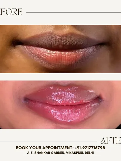 See the transformation with my permanent lip blush service. I corrected the dark pigmentation and gave her lips a beautiful, natural pink tint. This is perfect for anyone tired of reapplying lipstick and wanting an effortlessly defined look.