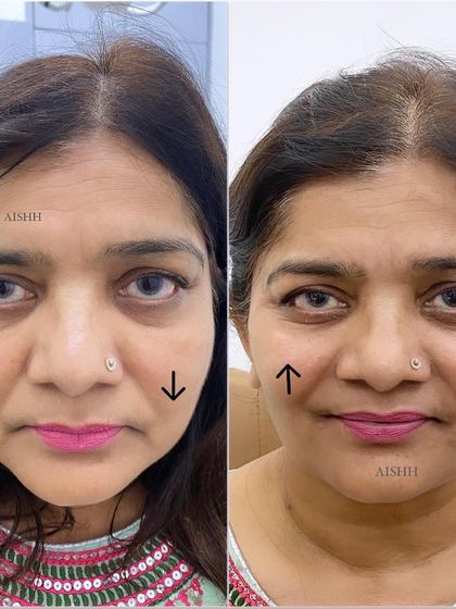 This frontal view shows how a cheek lift can restore youthful contours. The arrows indicate the area of lift, which helps to soften smile lines and create a more rested look.