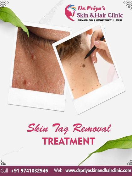 Priya J Talageri - Laser Tattoo & Blemish Removal Blemish, Mole, and Tag Removal photo 6