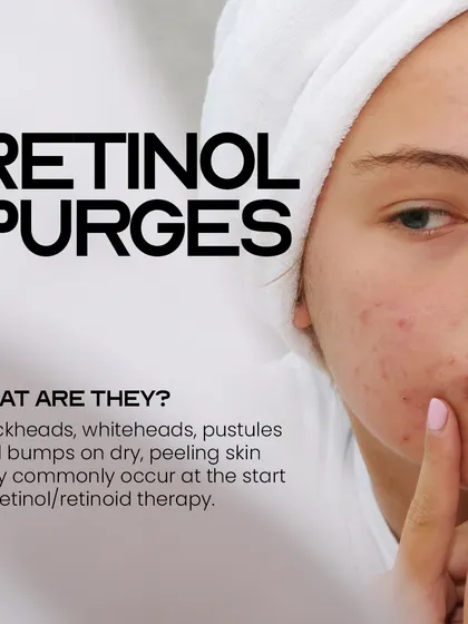 Understanding retinol purges is crucial. This initial breakout of blackheads, whiteheads, and bumps is a sign that the therapy is starting to work by increasing cell turnover.