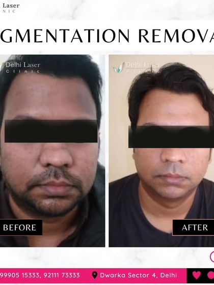 This client's transformation shows a significant reduction in facial hyperpigmentation. Using the Medlite C6 Q-Switch laser, I target and break down excess melanin to reveal clearer, more evenly toned skin.