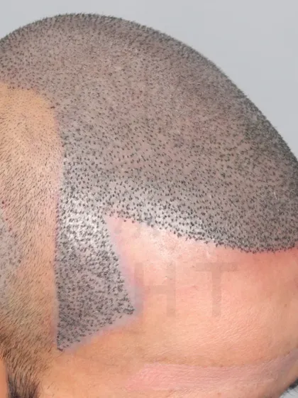 A high-grade baldness case just after surgery. 5700 grafts were used to recreate the hairline, frontal region, mid-scalp, crown, and temples.