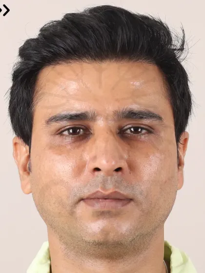 A 20-month transformation for a Diffuse Grade 5A patient. With 3800 grafts, we restored his hairline, frontal region, and mid-scalp for a lasting, natural look.