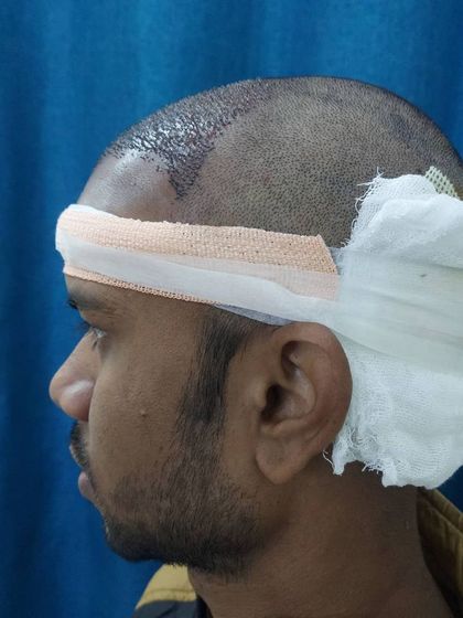 A side view of a patient with post-operative bandaging. We ensure proper care and dressing immediately after the procedure to protect the newly transplanted grafts.