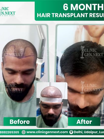 A remarkable change in just 6 months. The initial growth phase is well underway, showing a significant increase in hair coverage and the foundation for a full, dense result.