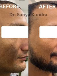 Non-Surgical Hair Restoration