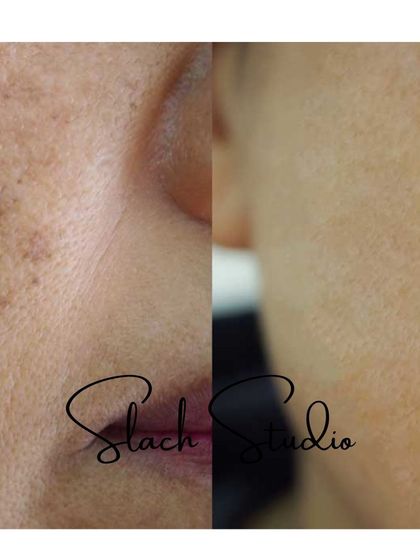This image highlights the reduction of fine, scattered pigmentation, leading to a much clearer and more uniform skin surface.