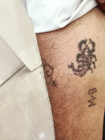 A before-photo of a patient's arm with homemade tattoos. Our laser technology can effectively remove such amateur tattoos in just a few sittings.