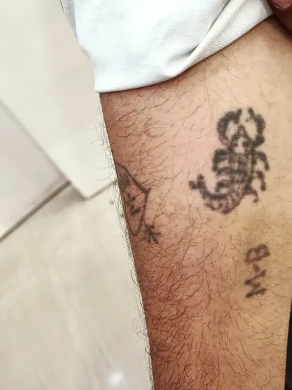 A before-photo of a patient's arm with homemade tattoos. Our laser technology can effectively remove such amateur tattoos in just a few sittings.