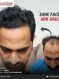 Hair Transplant Surgery