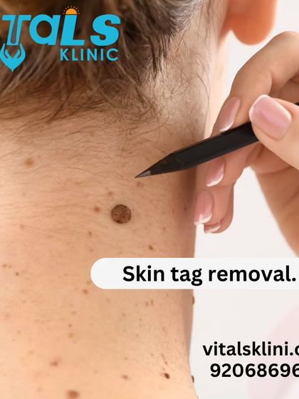Vitals Klinic - Dermatosurgery (Minor Procedures) Mole, Skin Tag & Growth Removal photo 4