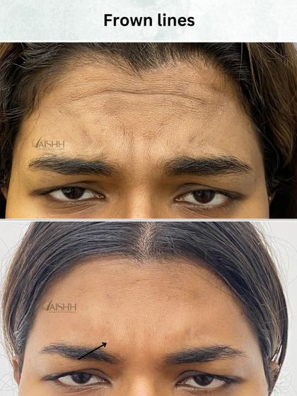 Here we have treated the "angry 11s" or frown lines between the eyebrows. Softening these lines makes the entire face look more rested and approachable.
