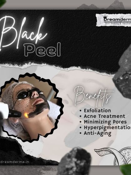 A client receiving a Black Peel treatment, which uses a carbon-based formula and laser to exfoliate, treat acne, minimize pores, and reduce hyperpigmentation.