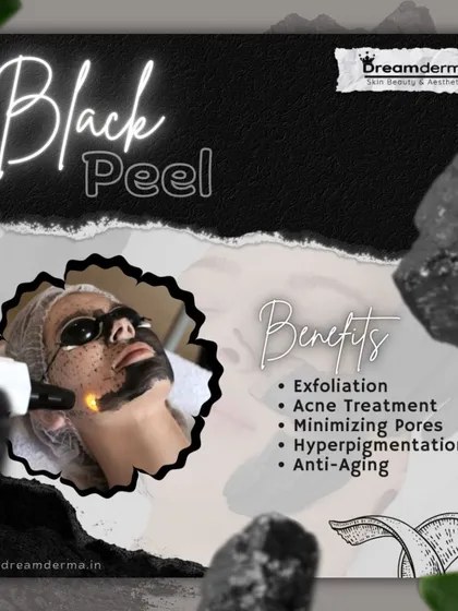 Our Black Peel treatment, a variation of the carbon peel, is a powerful solution for exfoliation, acne, minimizing pores, and reducing hyperpigmentation. It's an excellent anti-aging procedure for revitalizing your skin.