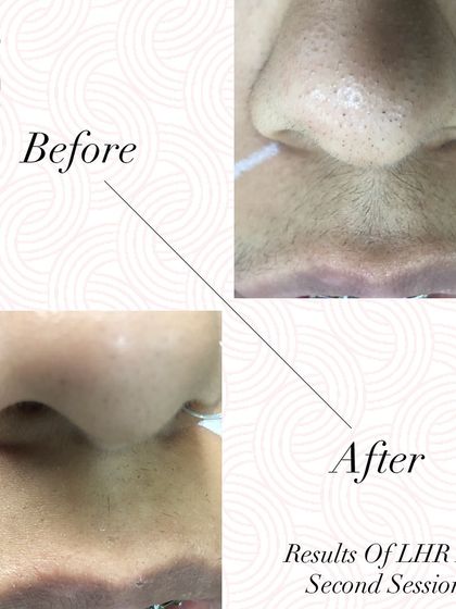 Tired of painful upper lip threading or waxing? This before and after shows the clear, smooth results after just the second session of laser hair removal on the upper lip area.