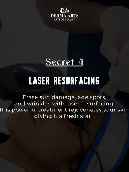 Laser resurfacing is a powerful anti-aging tool. It erases sun damage, age spots, and wrinkles, giving your skin a fresh start.