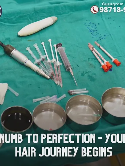 Here you can see some of the sterile, precision tools we use for our hair restoration procedures. From local anesthesia to the FUE punch and implanters, every instrument is chosen to ensure your journey is safe, comfortable, and effective.