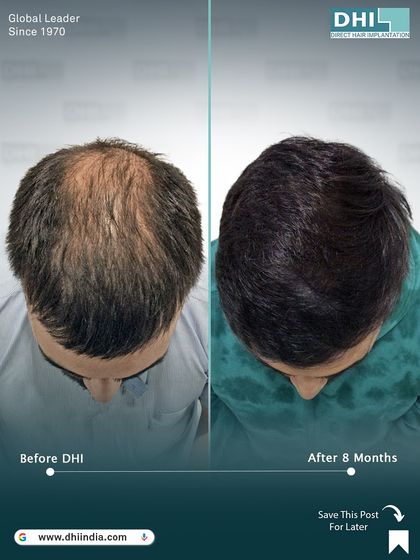 A top-down view showing the complete transformation of the crown and mid-scalp after 8 months. The result is a natural, dense head of hair that looks as if there was never any hair loss.