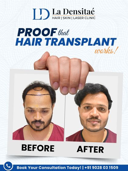 Tushar Shelke had tried everything for his hair loss without success. He chose my clinic for a real solution. With an RT-FUE hair transplant, we restored his hairline so naturally that it changed his life.