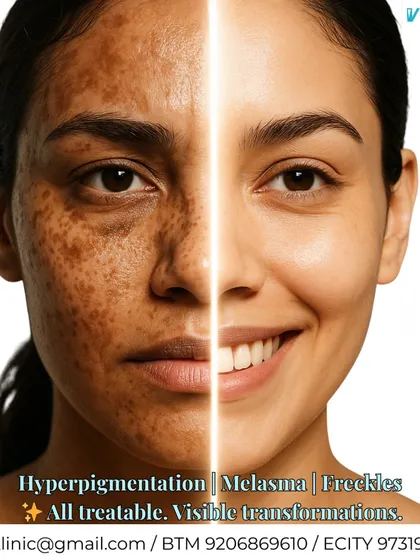 Hyperpigmentation, melasma, and freckles are common concerns that I treat effectively. This transformation shows how a targeted dermatological plan can restore an even, radiant skin tone by addressing pigment at its source.