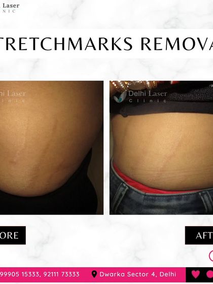 This image shows a significant reduction in the appearance of abdominal stretch marks after treatment. My approach helps to rebuild collagen and elastin, making the marks less visible and improving the skin's texture.