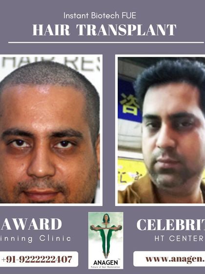 A complete 1 year result of an Instant Biotech FUE hair transplant. The patient has achieved a fantastic, long lasting result with great density.