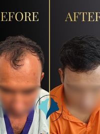 Hair Transplant
