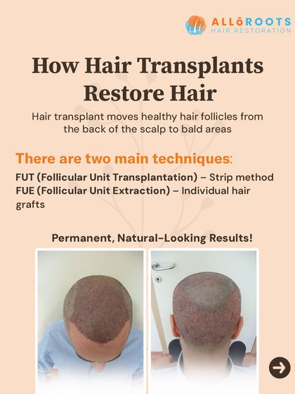 How do hair transplants restore hair? The procedure involves moving healthy, DHT-resistant hair follicles from the back of the scalp to the balding areas. This provides a permanent, natural-looking solution.