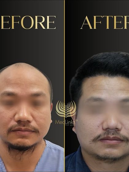 This before and after, with the patient's face blurred, shows a significant improvement in hair density and hairline design.
