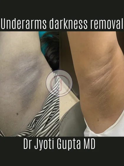 Dark underarms are a common issue, but they can be treated. This before-and-after shows a significant lightening of the underarm area using a combination of in-clinic peels and lifestyle advice.