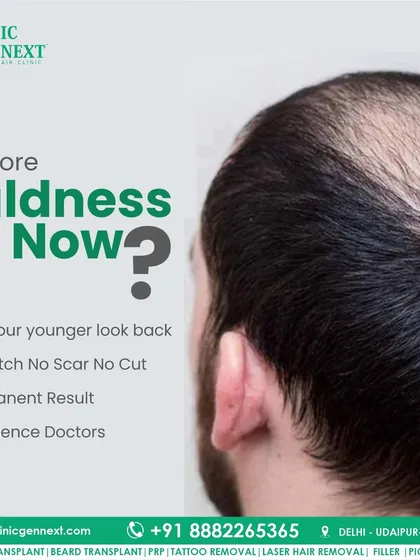 No more baldness. With modern FUE techniques, you can get your younger look back with no stitches, no scars, and a permanent result from an experienced doctor.