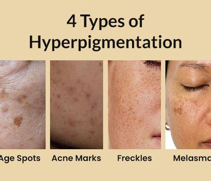 This image shows the four main types of hyperpigmentation I treat at my clinic. Understanding the cause, from age spots to melasma, is crucial for designing a successful treatment strategy.