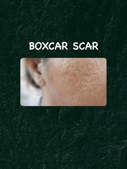 Here is a clinical example of boxcar scars. My treatment plans for these often involve procedures that rebuild the skin's underlying structure.