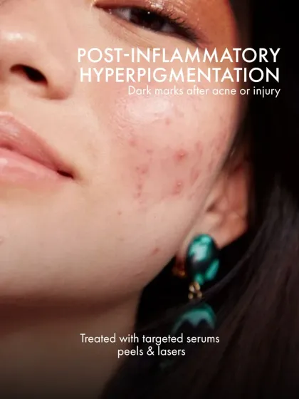 This visual shows an example of post-inflammatory hyperpigmentation. I treat these dark marks with a combination of targeted serums, chemical peels, and advanced lasers.