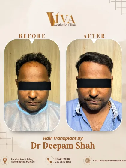 Here is the frontal view of the same patient. The key to a great hair transplant is ensuring the density looks full and the hairline doesn't appear as a harsh, straight line.